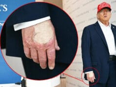 79-Year-Old Trump Admits Wearing Makeup on Hands, Compression Socks for Swollen Legs